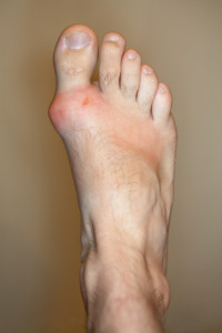 Foot with Gout