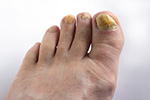 ongle-micose